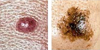照片比较正常和黑色素瘤痣显示不对称