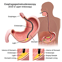 食管胃十二指肠镜检查程序插图
