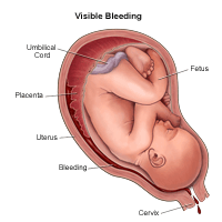 显示可见的出血的例证在怀孕期间