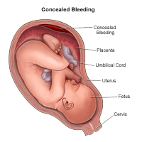 图示:妊娠期隐蔽性出血