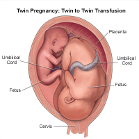 双胞胎出生的插图，双胞胎对孪生输血