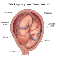 双胎出生的插图，头向下/头向上