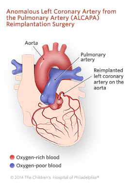 来自肺动脉再生手术插图的异常左冠状动脉