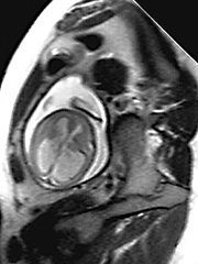 超快胎儿MRI