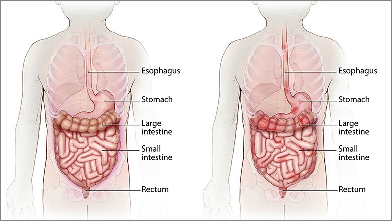 胃肠道正常与克罗恩病播种的插图