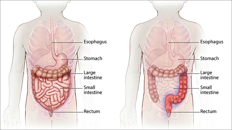 正常胃肠道vs.溃疡性结肠炎