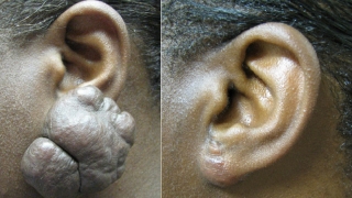 瘢痕疙瘩切除及耳垂修复的术前及术后。
