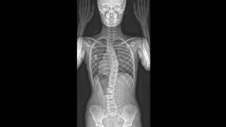 显示骨骼时代定位的脊柱侧凸X射线