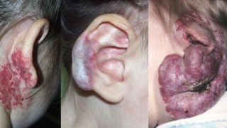 耳朵的血管瘤形象