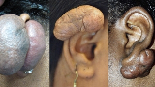 耳部瘢痕疙瘩的形象