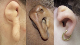 耳朵小耳症的形象