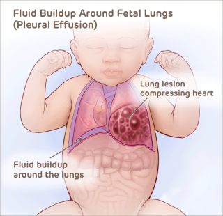 胎儿肺图解周围有积液