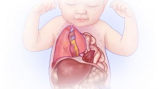 CDH的特写图显示腹部器官进入胸部