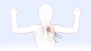 插图显示了在叫做胸腔镜片偏差术的患者手术手术过程中制作的两个切口
