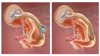 产前脊柱裂修复前后脊髓脊膜膨出胎儿