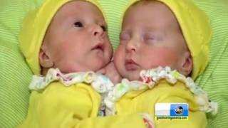 连体婴儿双胞胎