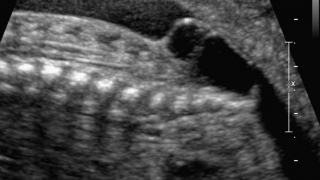 胎儿超声显示脊髓脊膜膨出缺陷
