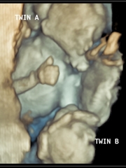 在3D胎儿超声中显示的TTT