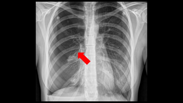倒塌肺X射线图像
