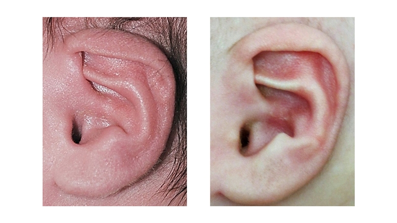 耳成型前后收缩的耳朵畸形