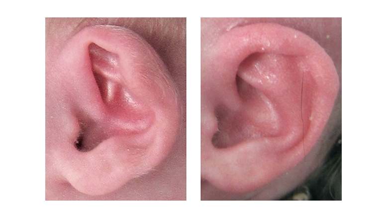 耳成型前后收缩的耳朵畸形