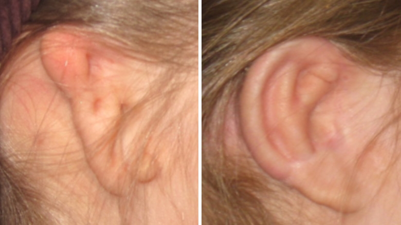 右耳肋骨软骨再造术前后小耳的观察
