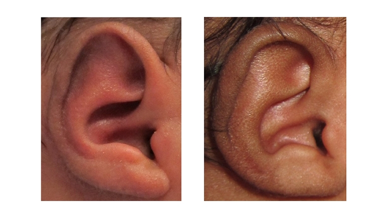 耳朵成型前后的Stahl的耳朵畸形