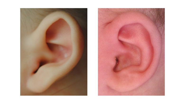耳朵成型前后的Stahl的耳朵畸形