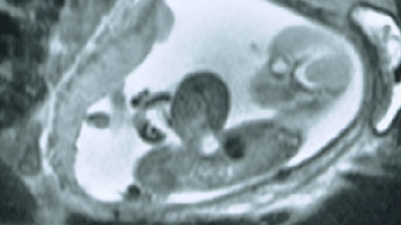 omphalocele胎儿MRI