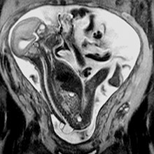胎儿MRI显示胎儿脊柱裂