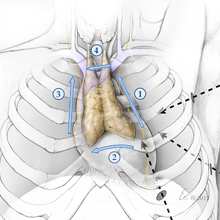 胸腺切除术内部图